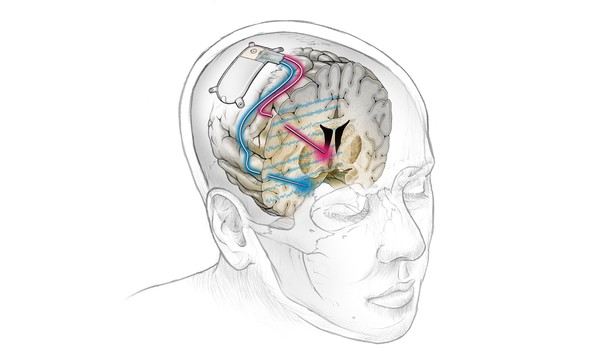 Устройство с одним выводом (синий) в миндалине для обнаружения биомаркера и другим (красным) в вентральной капсуле для стимуляции